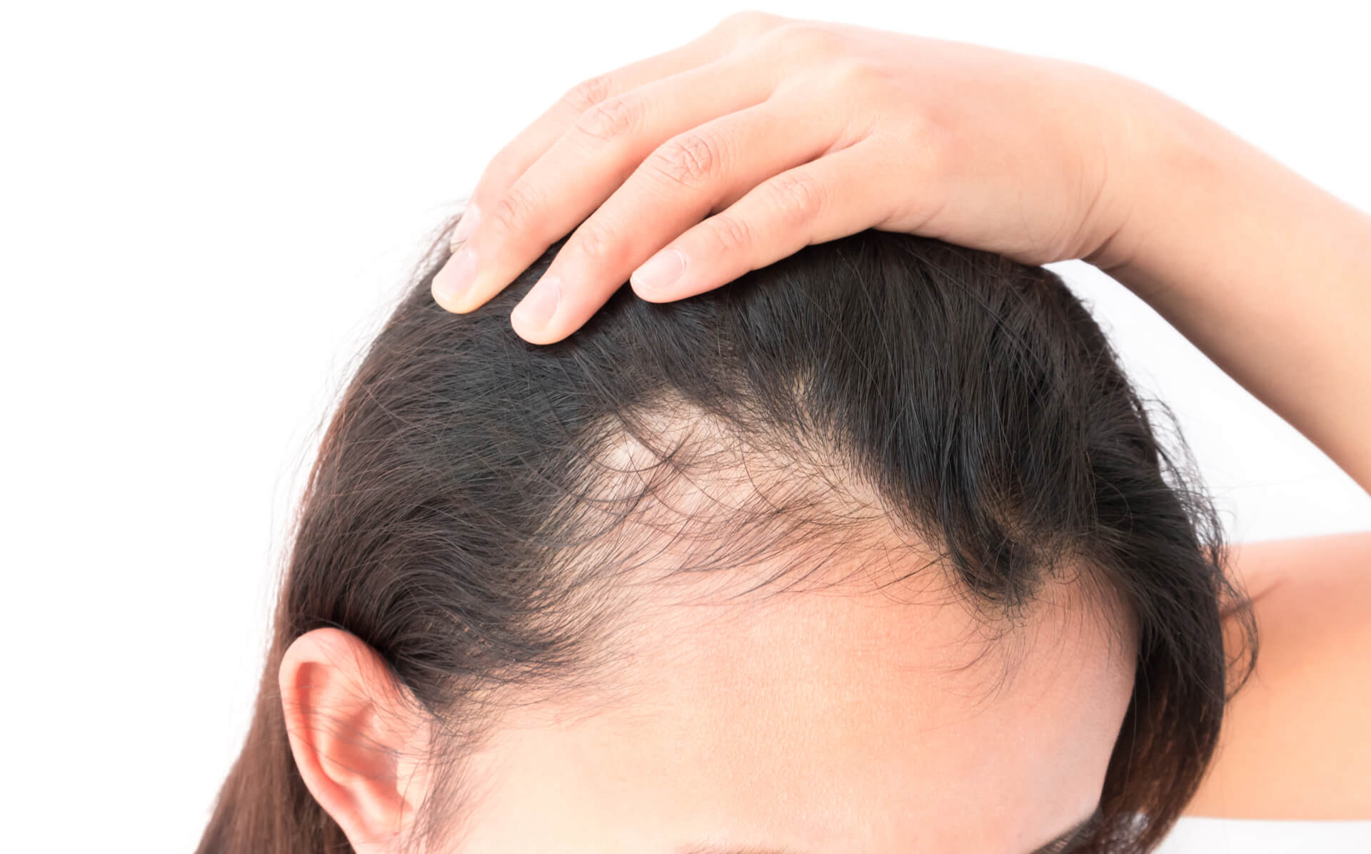 //millenniumhairclinic.ie/wp-content/uploads/2020/05/Millennium-Hair-loss-and-thinning.jpg